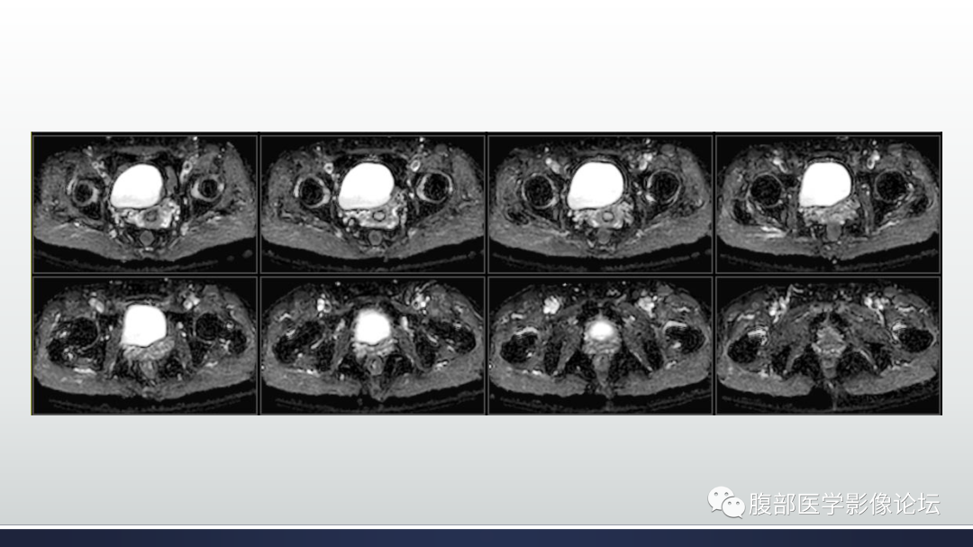 影像PPT - 【病例】膀胱非浸润性低级别乳头状尿路上皮癌1例MR影像-36