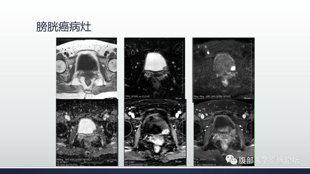 影像PPT - 【病例】膀胱非浸润性低级别乳头状尿路上皮癌1例MR影像-40