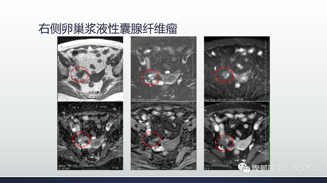 影像PPT - 【病例】膀胱非浸润性低级别乳头状尿路上皮癌1例MR影像-43