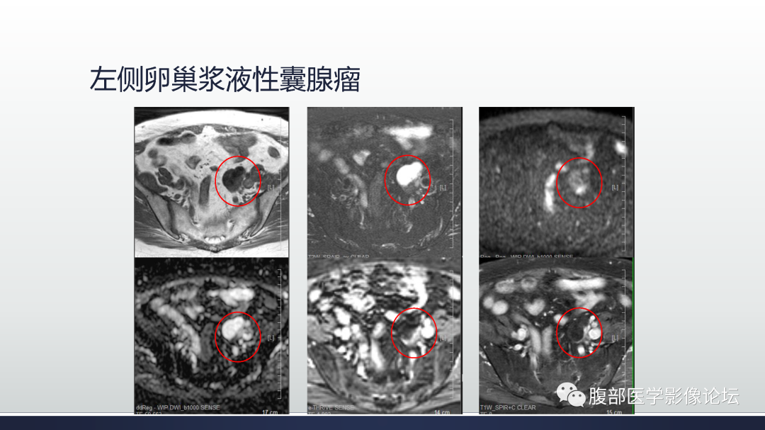 影像PPT - 【病例】膀胱非浸润性低级别乳头状尿路上皮癌1例MR影像-44
