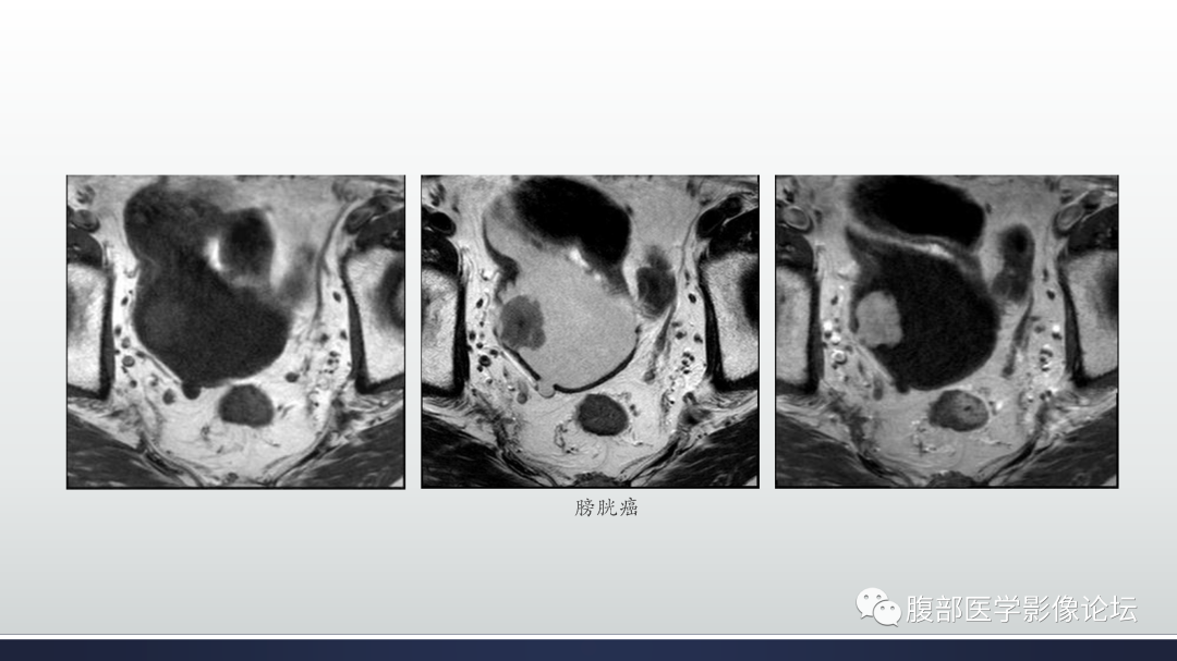 影像PPT - 【病例】膀胱非浸润性低级别乳头状尿路上皮癌1例MR影像-49