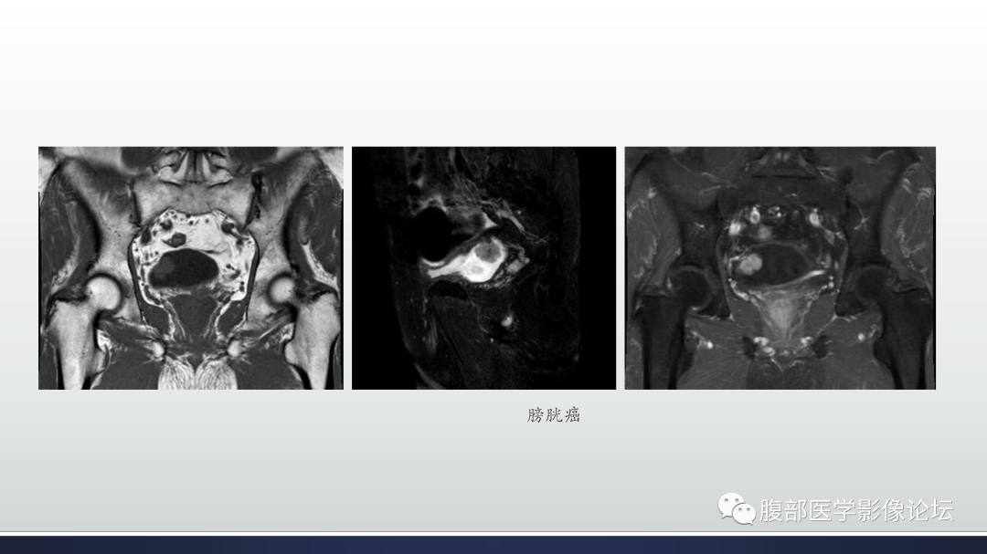 影像PPT - 【病例】膀胱非浸润性低级别乳头状尿路上皮癌1例MR影像-50