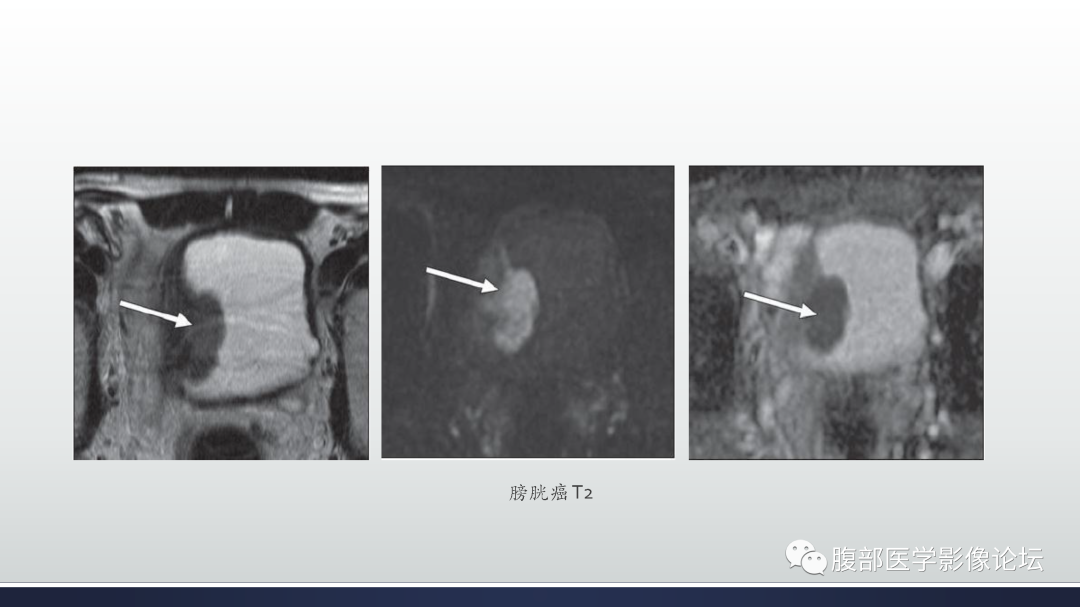 影像PPT - 【病例】膀胱非浸润性低级别乳头状尿路上皮癌1例MR影像-53