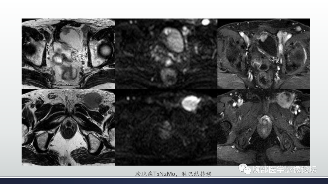 影像PPT - 【病例】膀胱非浸润性低级别乳头状尿路上皮癌1例MR影像-54
