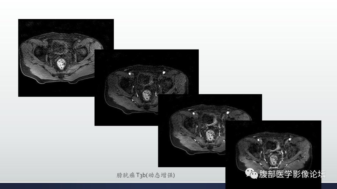 影像PPT - 【病例】膀胱非浸润性低级别乳头状尿路上皮癌1例MR影像-55