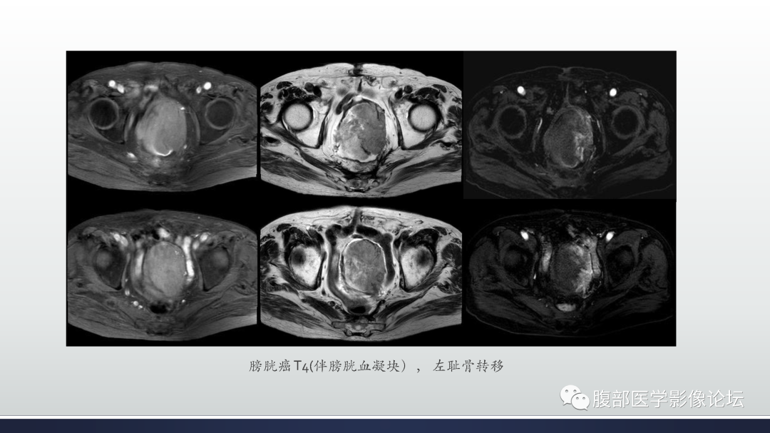 影像PPT - 【病例】膀胱非浸润性低级别乳头状尿路上皮癌1例MR影像-56