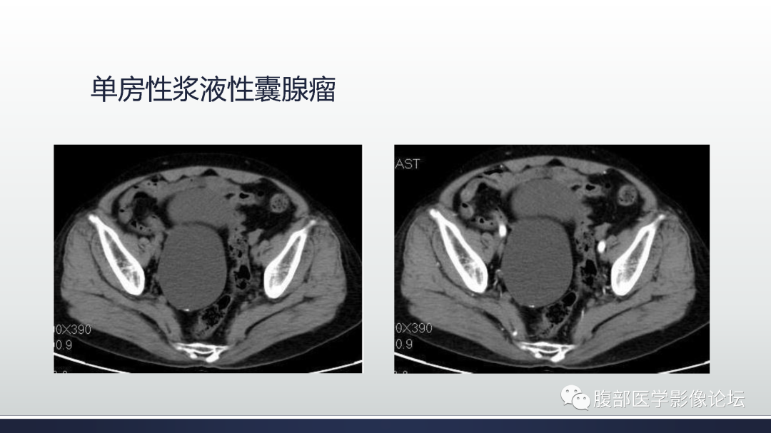 影像PPT - 【病例】膀胱非浸润性低级别乳头状尿路上皮癌1例MR影像-62