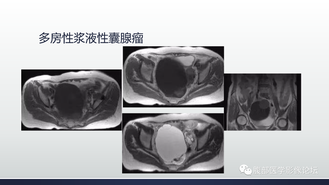 影像PPT - 【病例】膀胱非浸润性低级别乳头状尿路上皮癌1例MR影像-63