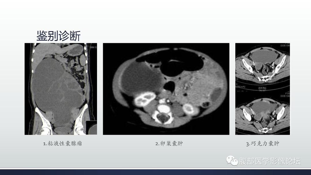 影像PPT - 【病例】膀胱非浸润性低级别乳头状尿路上皮癌1例MR影像-65