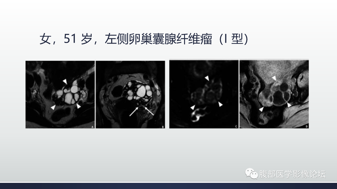 影像PPT - 【病例】膀胱非浸润性低级别乳头状尿路上皮癌1例MR影像-68