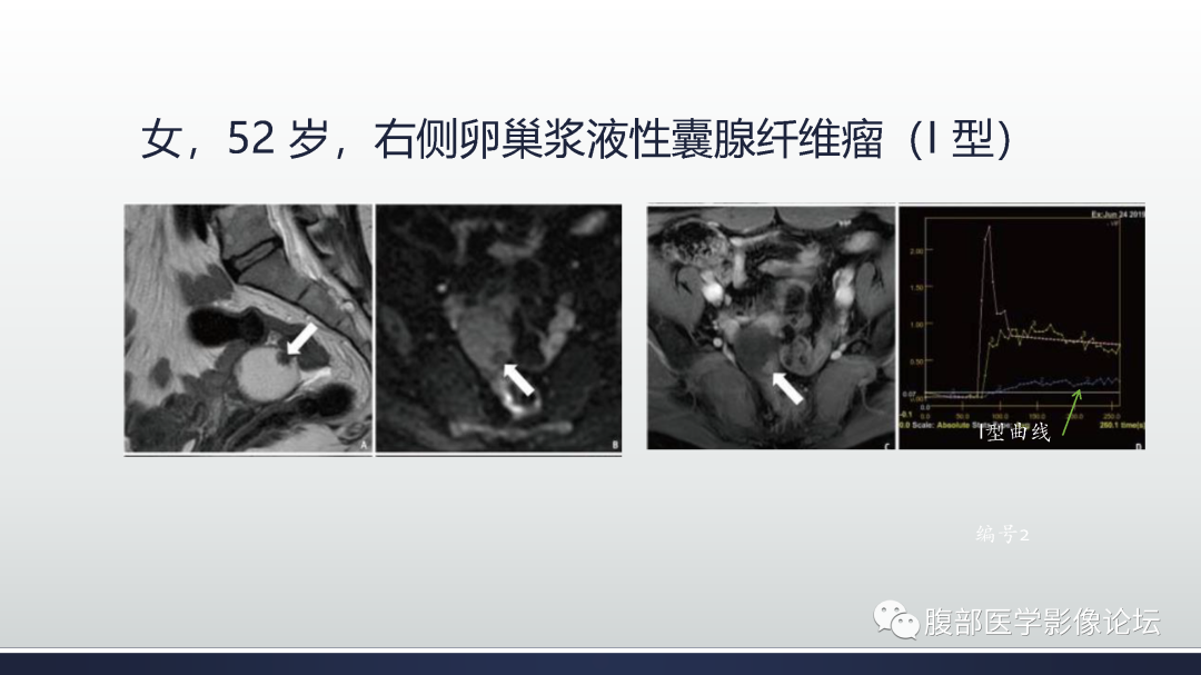 影像PPT - 【病例】膀胱非浸润性低级别乳头状尿路上皮癌1例MR影像-69