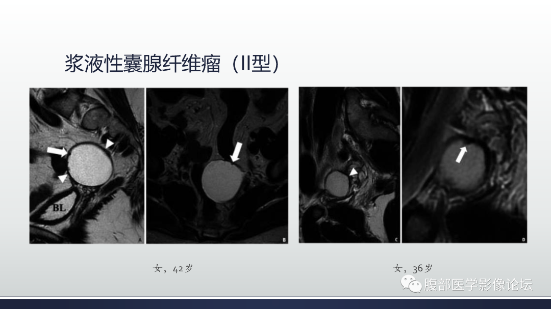 影像PPT - 【病例】膀胱非浸润性低级别乳头状尿路上皮癌1例MR影像-70