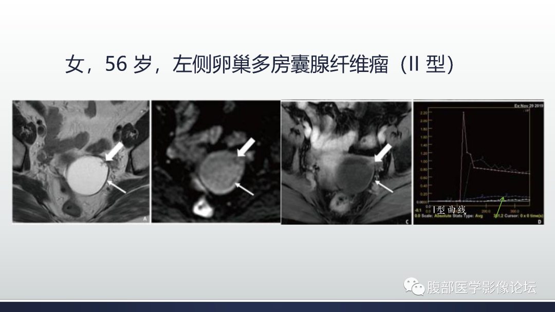 影像PPT - 【病例】膀胱非浸润性低级别乳头状尿路上皮癌1例MR影像-71