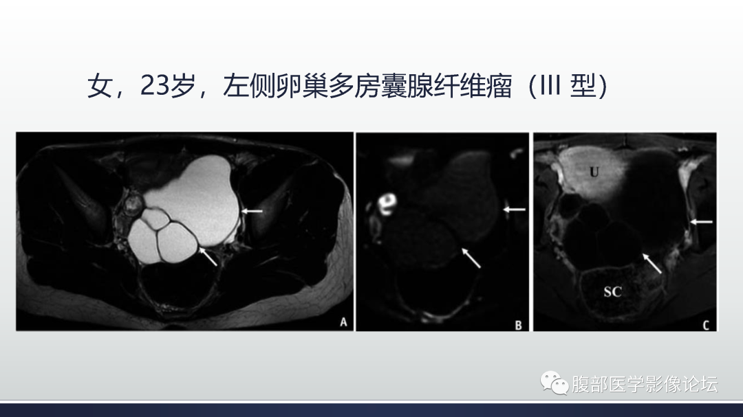 影像PPT - 【病例】膀胱非浸润性低级别乳头状尿路上皮癌1例MR影像-72