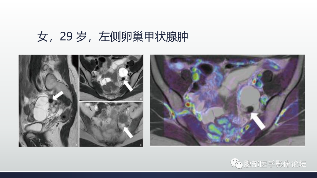 影像PPT - 【病例】膀胱非浸润性低级别乳头状尿路上皮癌1例MR影像-74