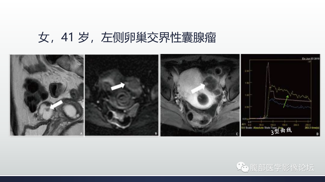 影像PPT - 【病例】膀胱非浸润性低级别乳头状尿路上皮癌1例MR影像-75
