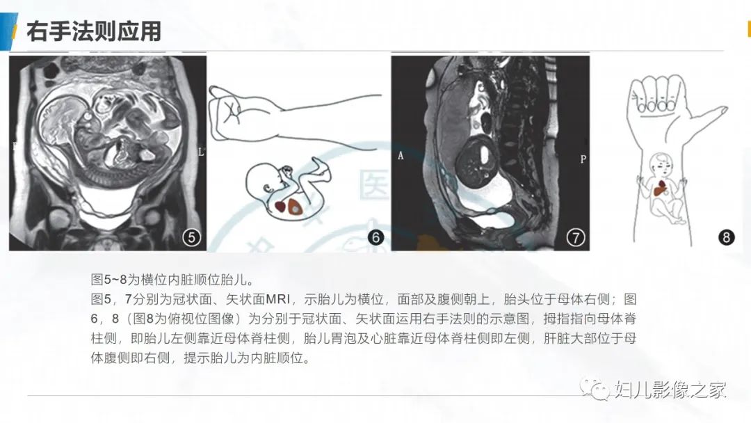 影像PPT - 【PPT】右手法则在MRI胎儿左右方位判定中的应用-8