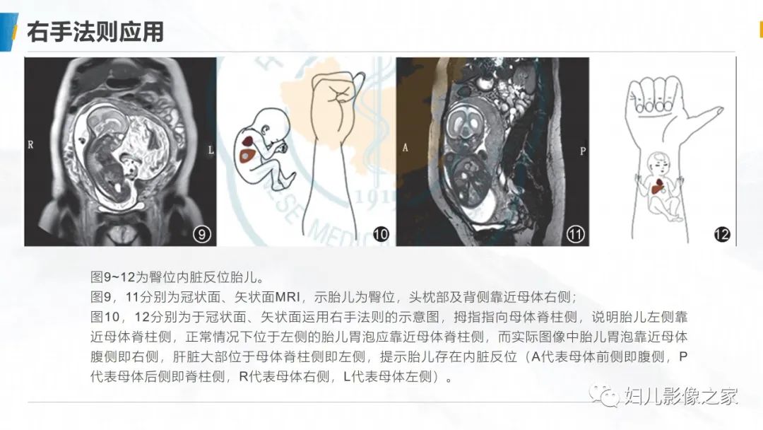 影像PPT - 【PPT】右手法则在MRI胎儿左右方位判定中的应用-9