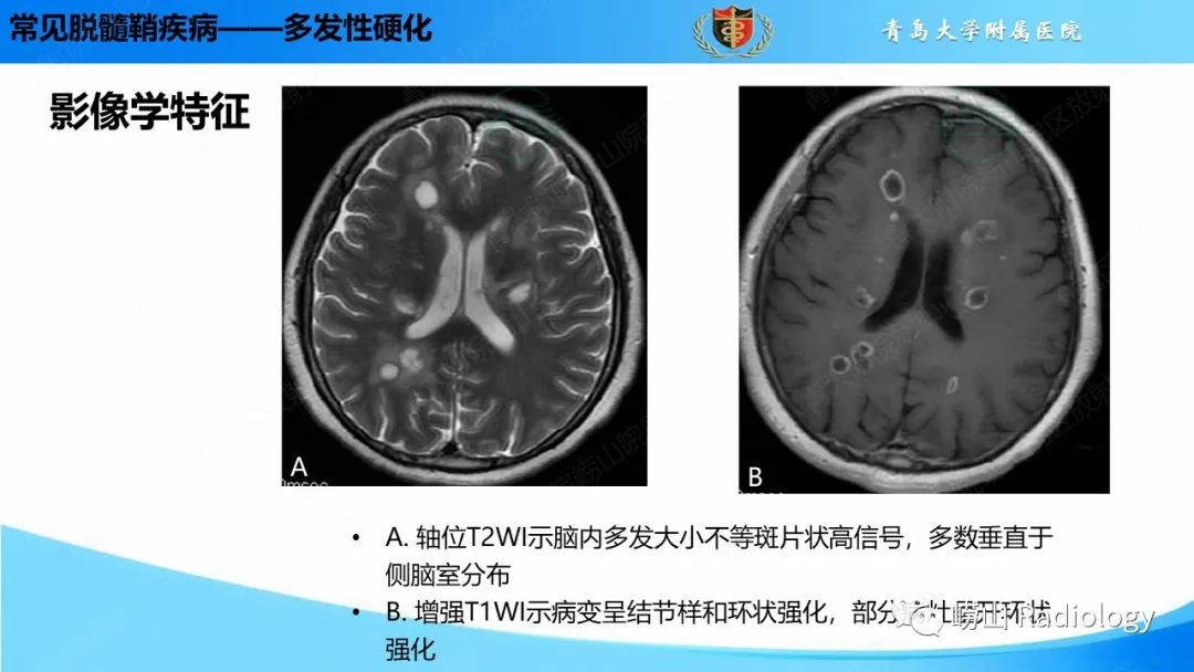 影像PPT - 【PPT】脱髓鞘疾病-10