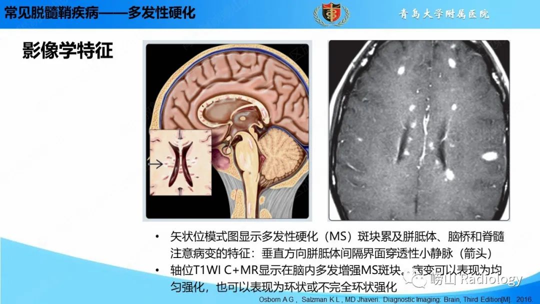 影像PPT - 【PPT】脱髓鞘疾病-11