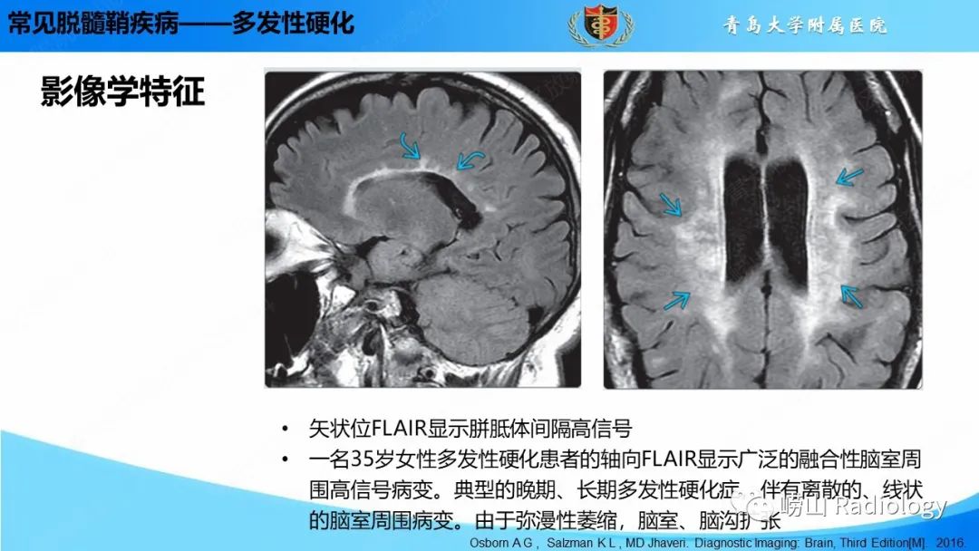 影像PPT - 【PPT】脱髓鞘疾病-12