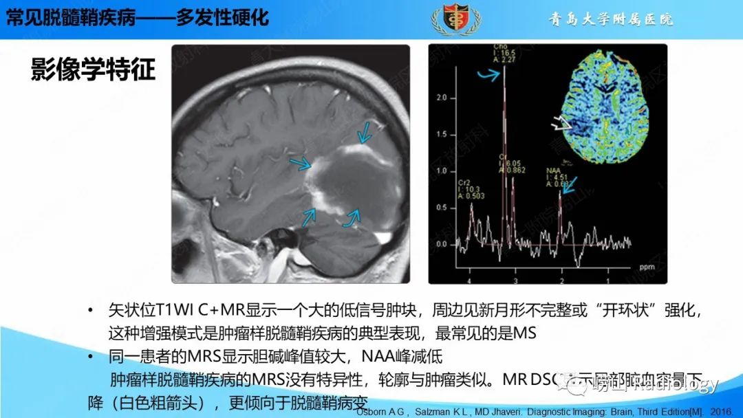 影像PPT - 【PPT】脱髓鞘疾病-14