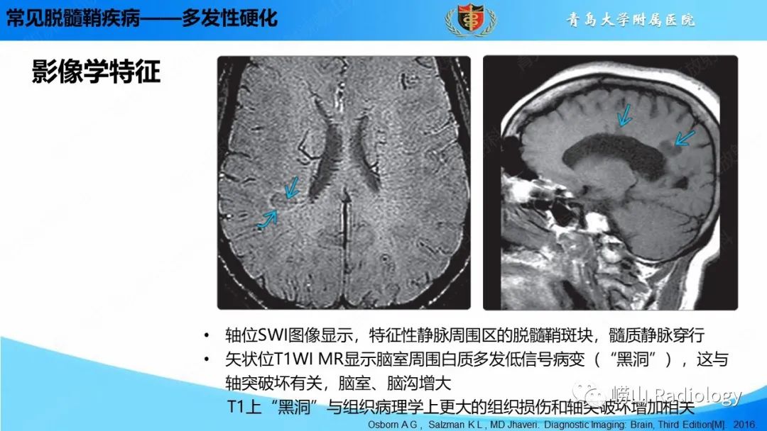 影像PPT - 【PPT】脱髓鞘疾病-13