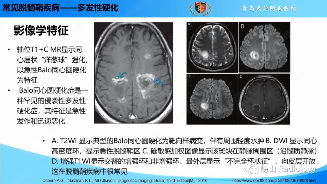 影像PPT - 【PPT】脱髓鞘疾病-15