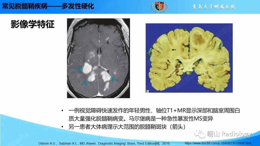影像PPT - 【PPT】脱髓鞘疾病-16
