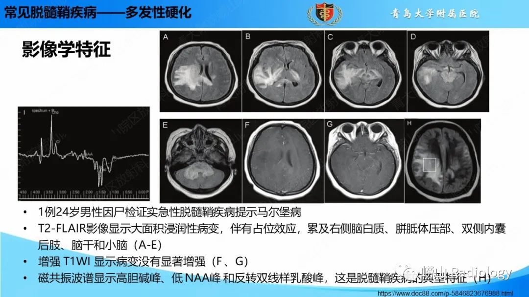 影像PPT - 【PPT】脱髓鞘疾病-17