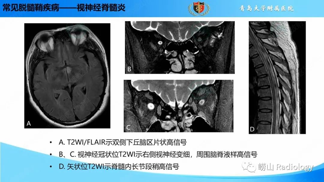影像PPT - 【PPT】脱髓鞘疾病-21