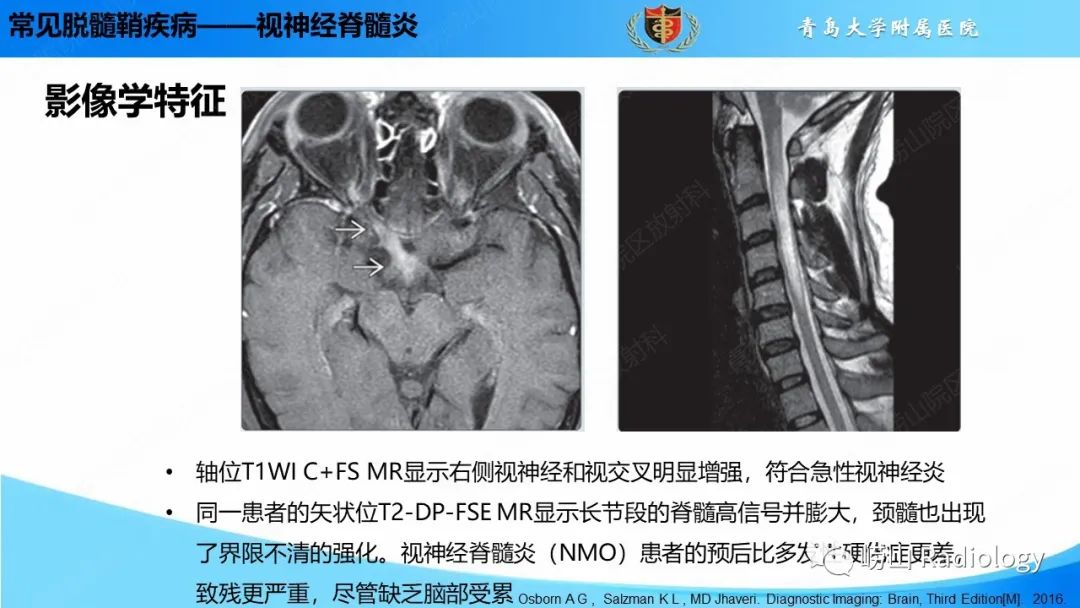 影像PPT - 【PPT】脱髓鞘疾病-22