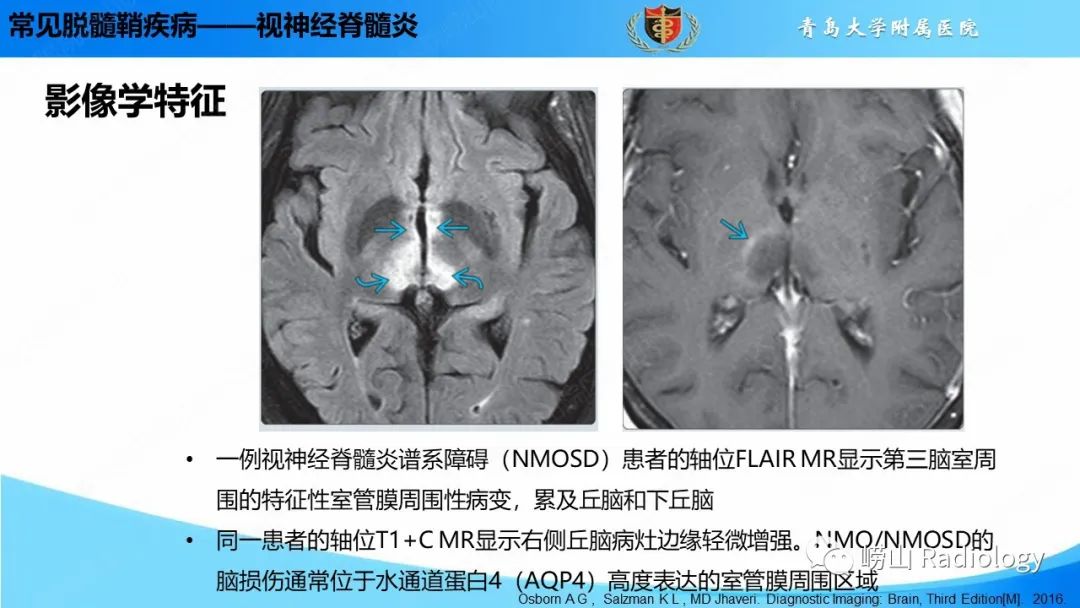 影像PPT - 【PPT】脱髓鞘疾病-23