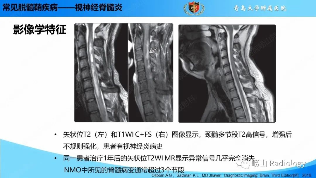 影像PPT - 【PPT】脱髓鞘疾病-24