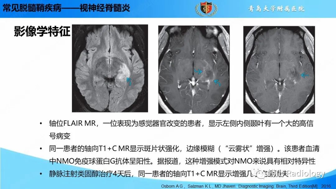 影像PPT - 【PPT】脱髓鞘疾病-25