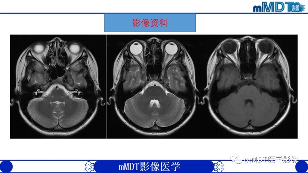 影像PPT - 【PPT】双侧海绵窦结节病—神经结节病综述-5