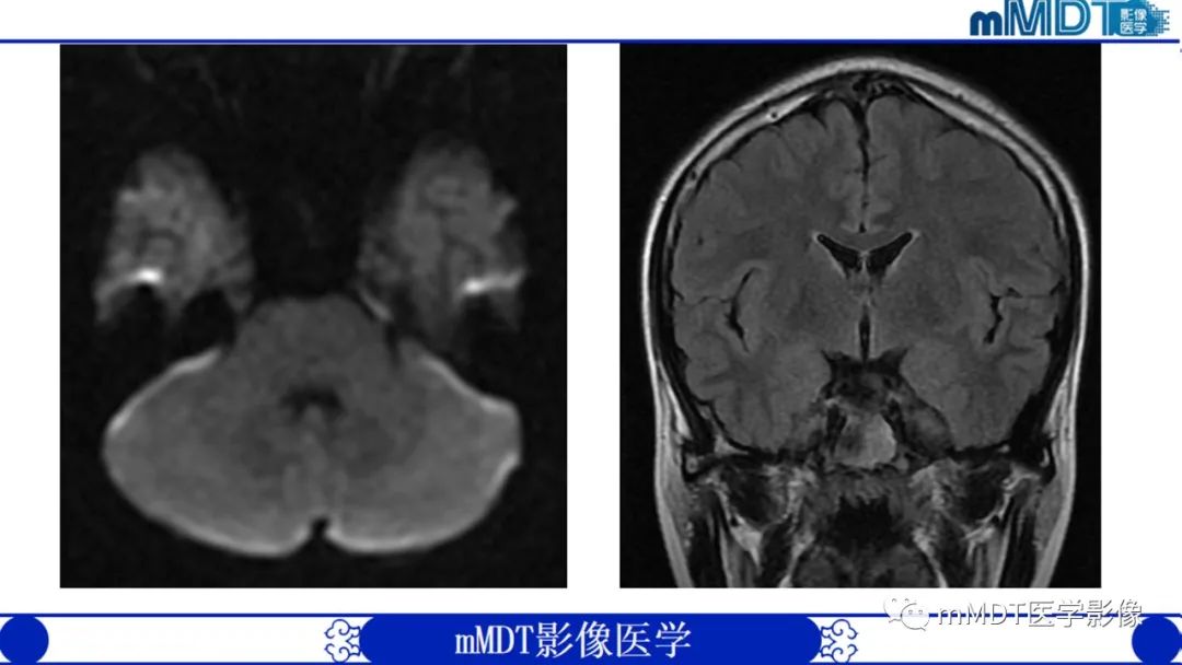 影像PPT - 【PPT】双侧海绵窦结节病—神经结节病综述-6