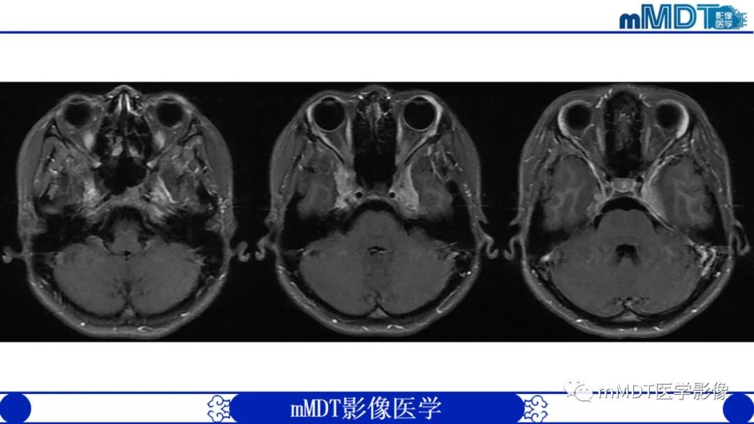 影像PPT - 【PPT】双侧海绵窦结节病—神经结节病综述-7