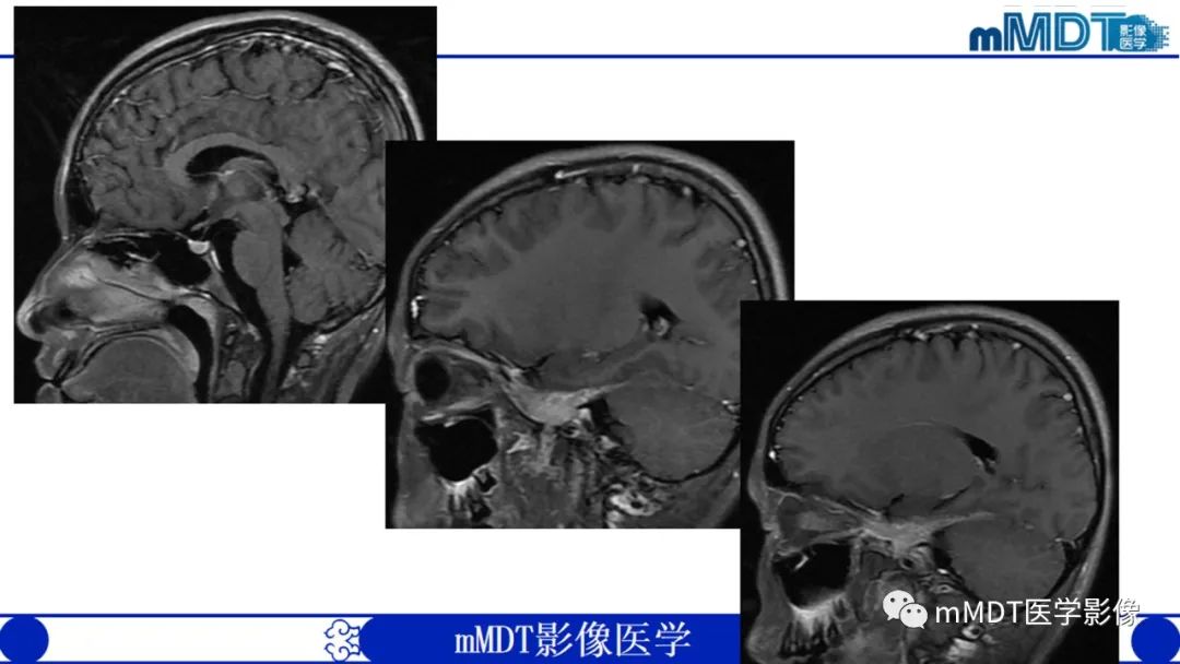 影像PPT - 【PPT】双侧海绵窦结节病—神经结节病综述-9