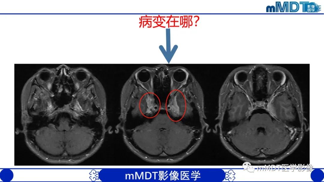 影像PPT - 【PPT】双侧海绵窦结节病—神经结节病综述-10