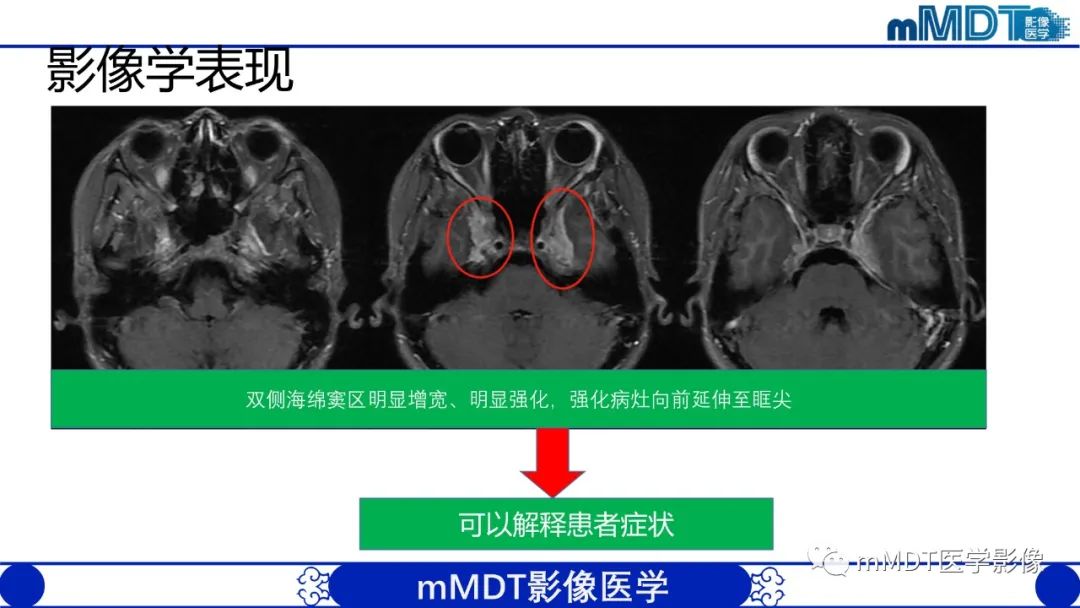 影像PPT - 【PPT】双侧海绵窦结节病—神经结节病综述-11