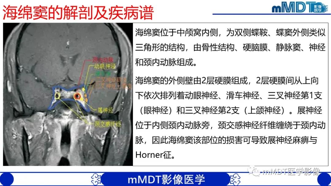 影像PPT - 【PPT】双侧海绵窦结节病—神经结节病综述-12