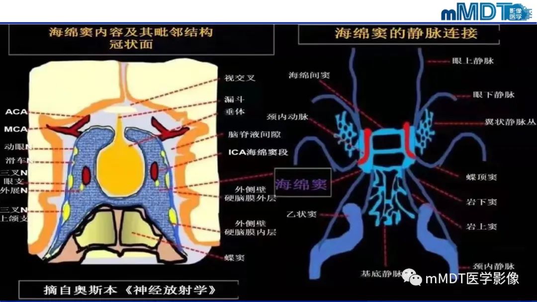 影像PPT - 【PPT】双侧海绵窦结节病—神经结节病综述-13