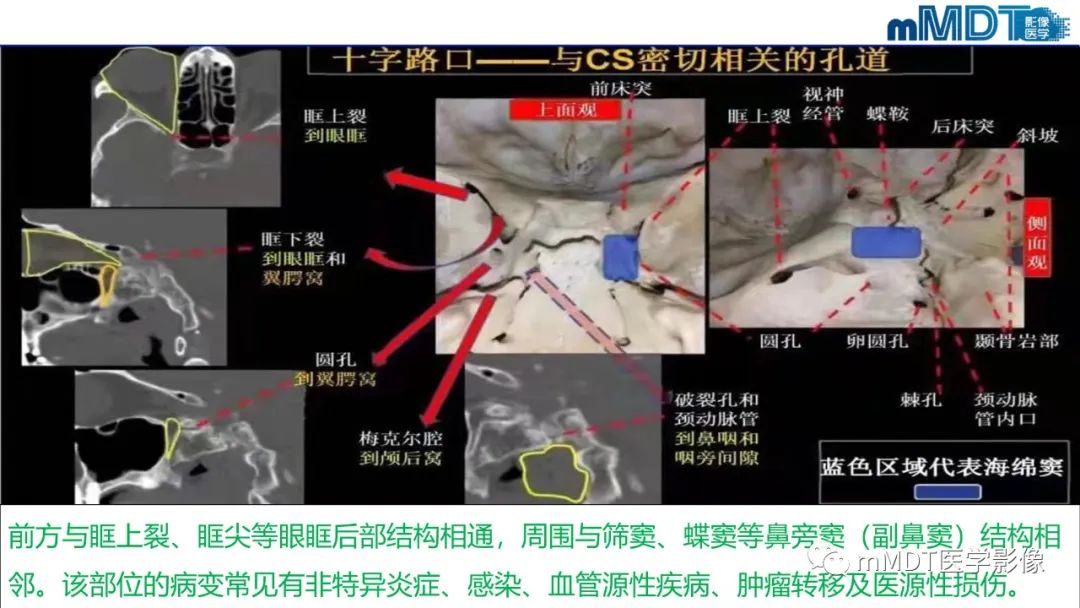 影像PPT - 【PPT】双侧海绵窦结节病—神经结节病综述-14