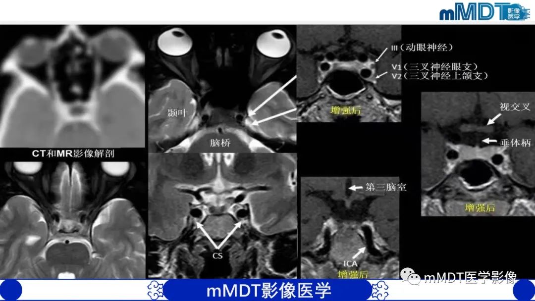 影像PPT - 【PPT】双侧海绵窦结节病—神经结节病综述-15