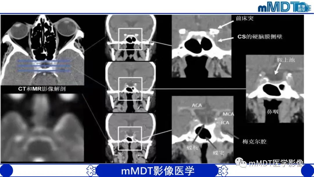 影像PPT - 【PPT】双侧海绵窦结节病—神经结节病综述-16