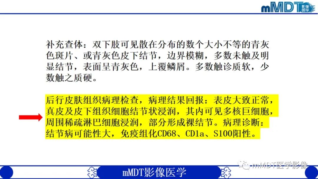 影像PPT - 【PPT】双侧海绵窦结节病—神经结节病综述-19
