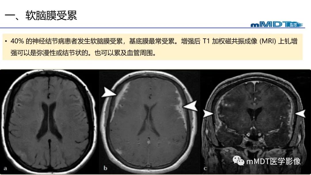 影像PPT - 【PPT】双侧海绵窦结节病—神经结节病综述-23