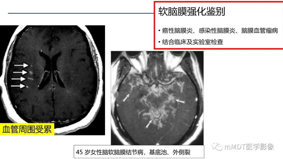影像PPT - 【PPT】双侧海绵窦结节病—神经结节病综述-24