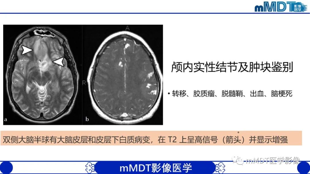 影像PPT - 【PPT】双侧海绵窦结节病—神经结节病综述-26
